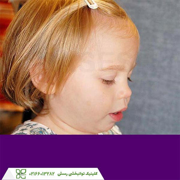  این دختر کوچک، ناحیه میانی صورت کوتاهتری را در ناحیه بین چشم ها و لب بالا نشان می دهد.