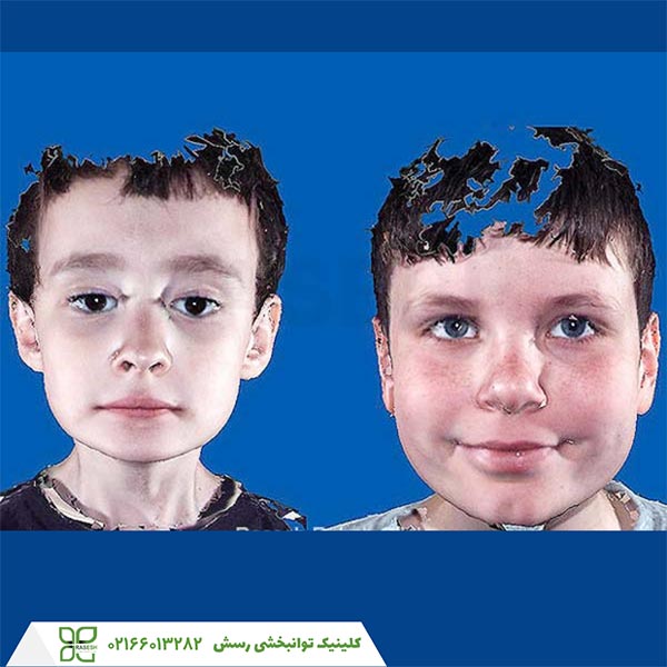 کودکان مبتلا به اوتیسم دارای دهان و فیلتروم (شیار زیر بینی و بالای لب) بزرگتر یا پهن تری هستند.