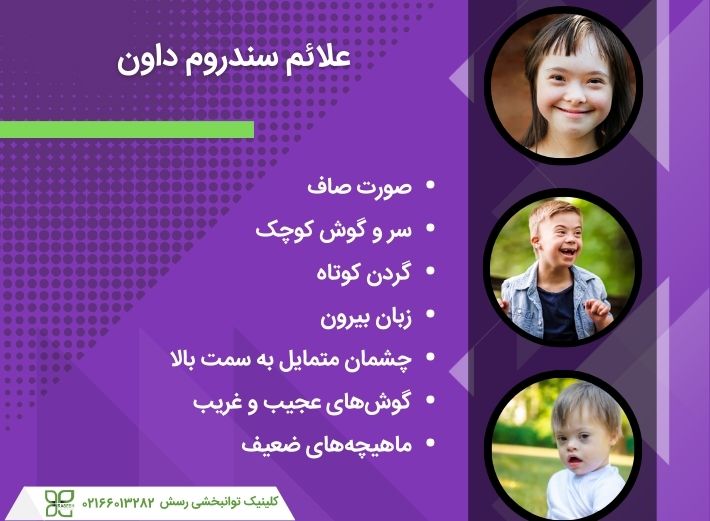 علائم سندرم داون