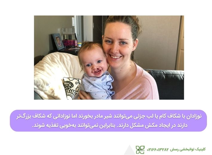 تأثیر شکاف کام و لب بر شیردهی  