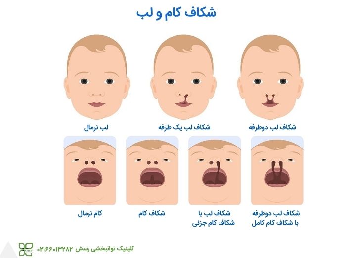 انواع مختلف شکاف کام و لب 