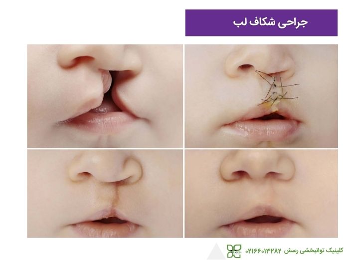 جراحی شکاف کام و لب