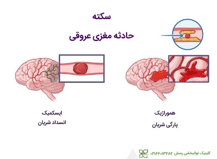 انواع سکته مغزی