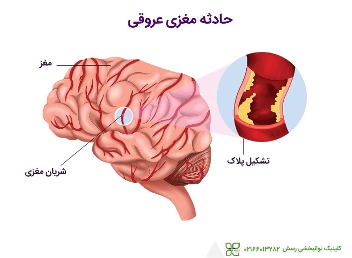 حادثه مغزی عروقی