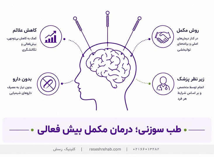 طب سوزنی به&zwnj;عنوان درمان مکمل بیش فعالی