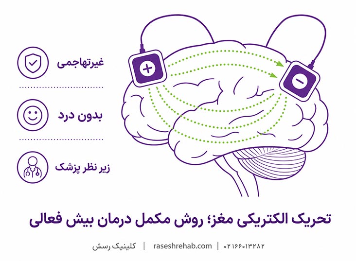 تحریک الکتریکی مغز (tDCS)