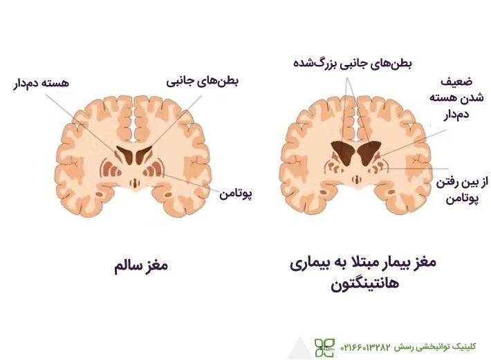 بیماری هانتینگتون 