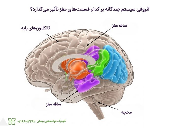 نحوه تاثیر آتروفی سیستم چندگانه بر مغز
