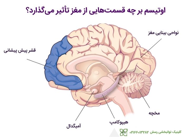 اوتیسم بر قسمت های مختلف مغز تاثیر می گذارد