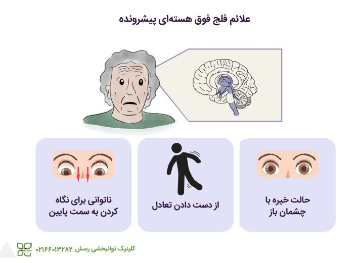 علائم فلج فوق هستهای پیشرونده