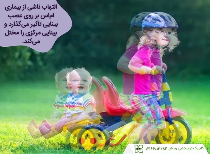 ام اس بر روی بینایی تأثیر میگذارد.