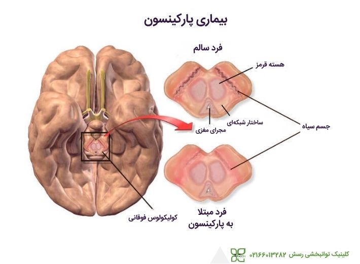 بیماری پارکینسون چیست؟