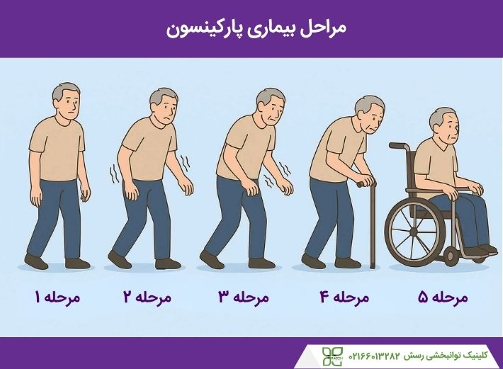 مراحل بیماری پارکینسون
