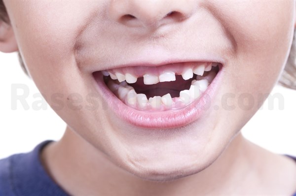 تشخیص اوتیسم از طریق دندان