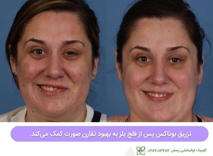 تزریق بوتاکس برای بهبود تقارن صورت بعد از ابتلا به فلج بلز