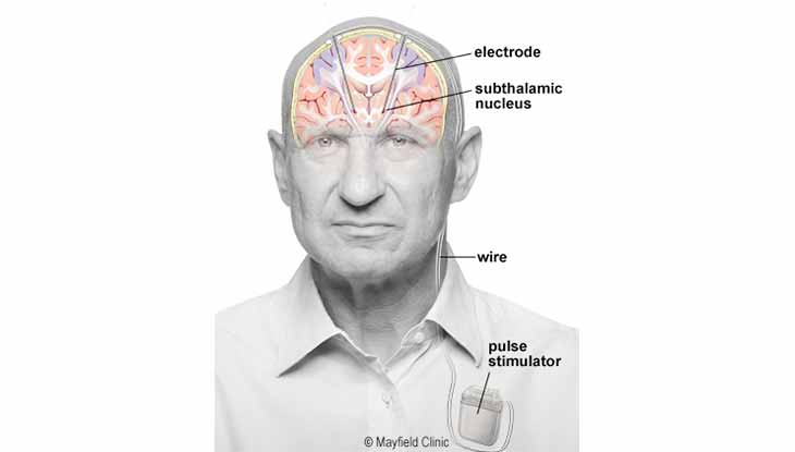 ساختار-دستگاه-DBS