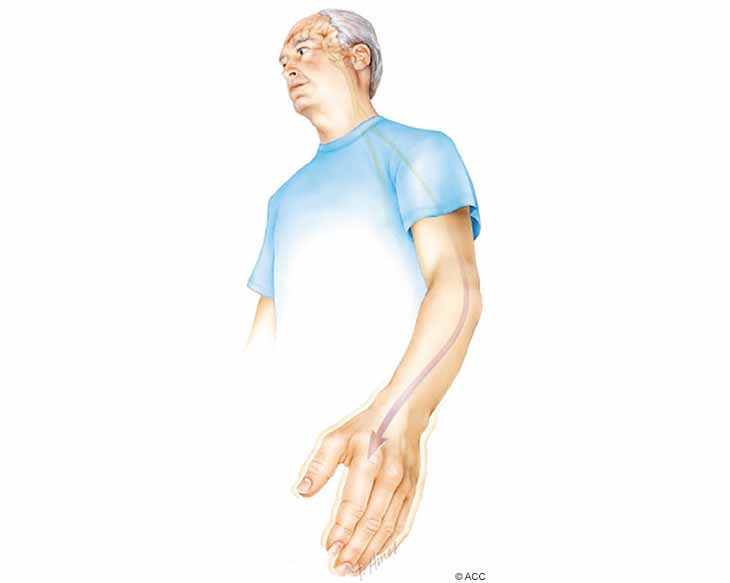 اختلال حرکتی در پارکینسون