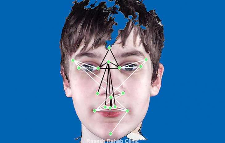 آیا اوتیسم است؟ ویژگی های چهره کودکان اوتیسم که می تواند نشان دهنده این اختلال باشد